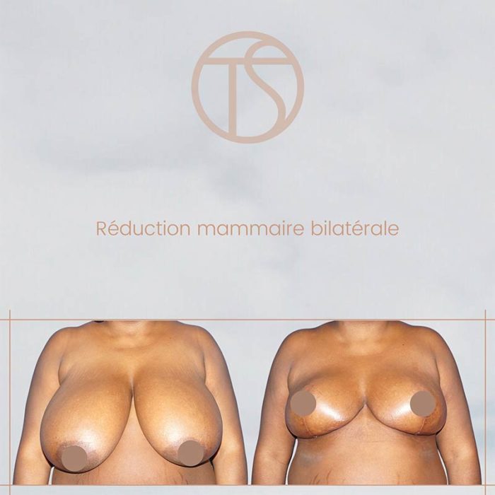 Reduction mammaire bordeaux