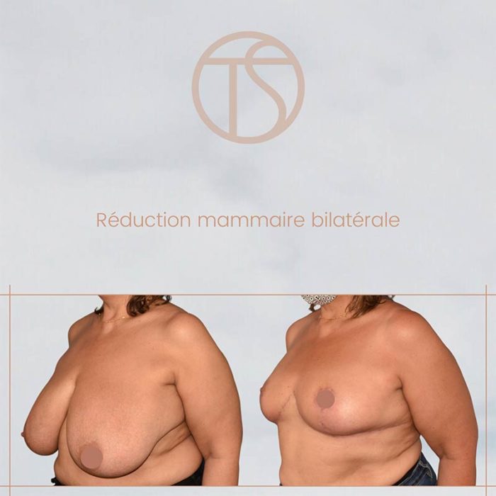 Reduction mammaire bordeaux