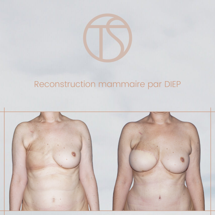 La reconstruction mammaire par lambeau de DIEP - Docteur Thomas ...