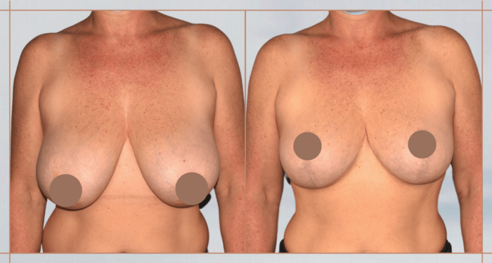 reduction-mammaire-bilaterale-avant-apres
