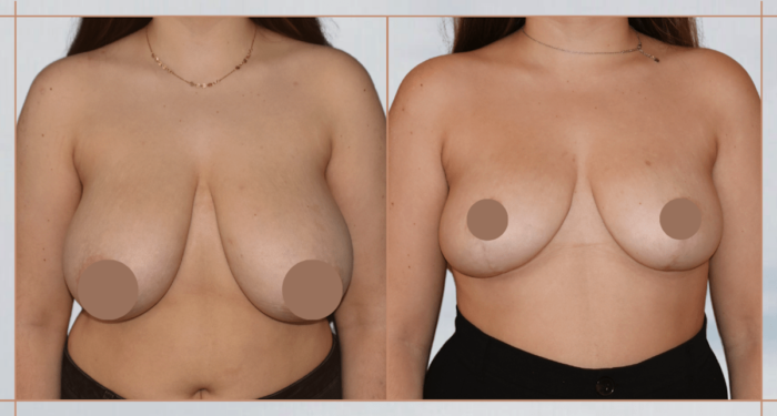 reduction-mammaire-bilaterale-avant-apres