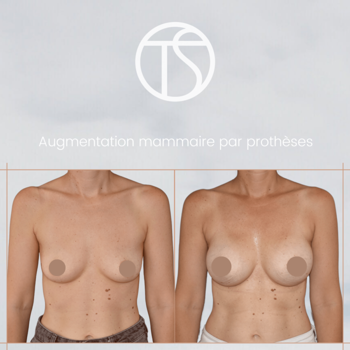 augmentation-mammaire-protheses-avant-apres