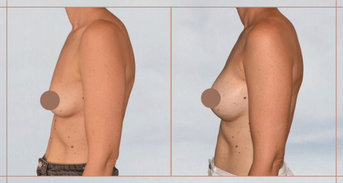 augmentation-mammaire-protheses-avant-apres